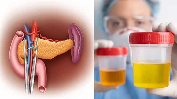 Health: మూత్రంలో ఈ లక్షణాలా.? క్లోమగ్రంథి దెబ్బతినొచ్చు..