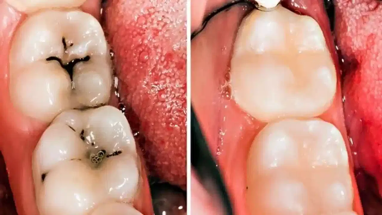 సాధారణంగా అందరూ కేవలం రోజుకు ఒకసారి మాత్రమే పళ్లను క్లీన్ చేస్తూ ఉంటారు. కానీ రోజుకు రెండు సార్లు క్లీన్ చేయాలని వైద్యులు సూచిస్తూ ఉంటారు. రాత్రి పళ్లను క్లీన్ చేయడం వల్ల ఎక్కువగా బ్యాక్టీరియా ఎటాక్ అవ్వకుండా ఉంటాయి.  అంతే కాకుండా పంటి గ్యాప్స్ లో కూడా క్లీన్ చేస్తూ ఉండాలి. 
