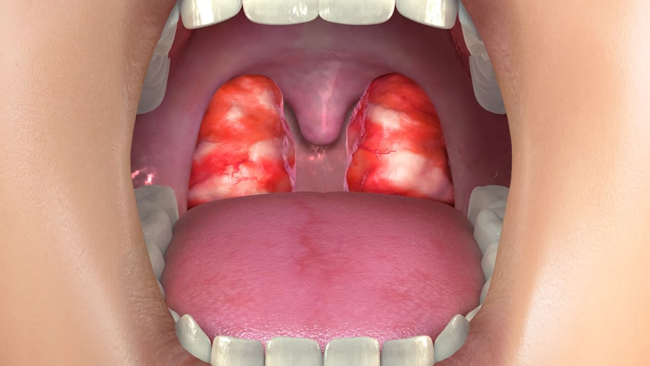 Home Remedies for Tonsils: టాన్సిల్స్ తో ఇబ్బంది పడుతున్నారా.. ఈ ఇంటి టిప్స్ పాటిస్తే ఖర్చు లేకుండా తగ్గించు కోవచ్చు!