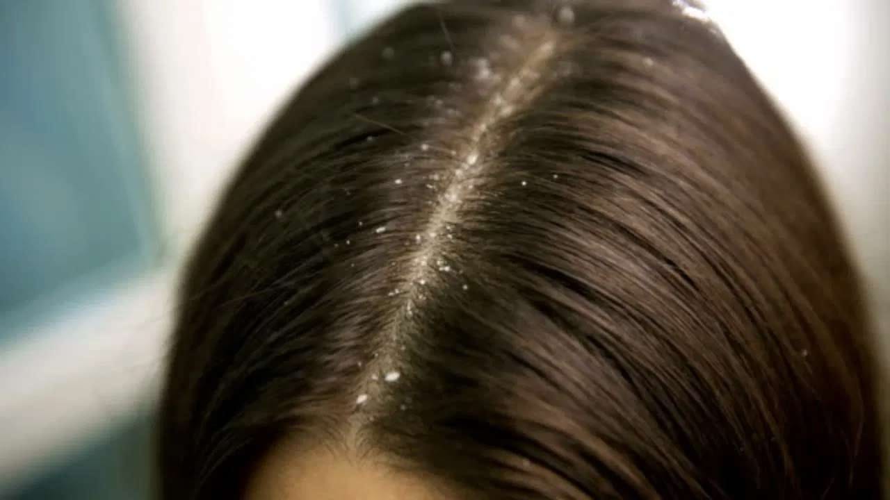 ఉల్లిపాయలు జుట్టు సమస్యల నివారణలో ప్రభావవంతంగా పనిచేస్తుందనే విషయం అందరికీ తెలిసిందే. ఉల్లిపాయ రసం నూనె జుట్టు పెరుగుదలను ప్రోత్సహించడంలో, జుట్టు రాలడాన్ని తగ్గించడంలో సహాయపడుతుంది. కానీ ఉల్లిపాయల మాదిరి వెల్లుల్లి కూడ జుట్టు సమస్యల నివారణలో దోహదపడుతుందని అంటున్నారు నిపుణులు. వెల్లుల్లి ఆహారానికి రుచిని ఇవ్వడమే కాకుండా శరీరంలో రోగనిరోధక శక్తిని పెంచడానికి కూడా సహాయపడుతుంది. అలాగే వెల్లుల్లి జుట్టు సమస్యలను కూడా పరిష్కరిస్తుంది. వెల్లుల్లి నూనె జుట్టుకు పోషణనిచ్చి వెంట్రుకల పెరుగుదలను ప్రోత్సహిస్తుంది.