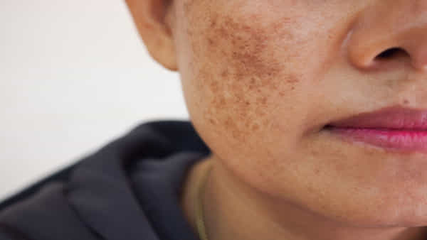 Hyper Pigmentation: ముఖంపై నల్ల మచ్చలు ఎక్కువగా ఉన్నాయా.. ఈ చిట్కాలతో మాయం చేయండి!