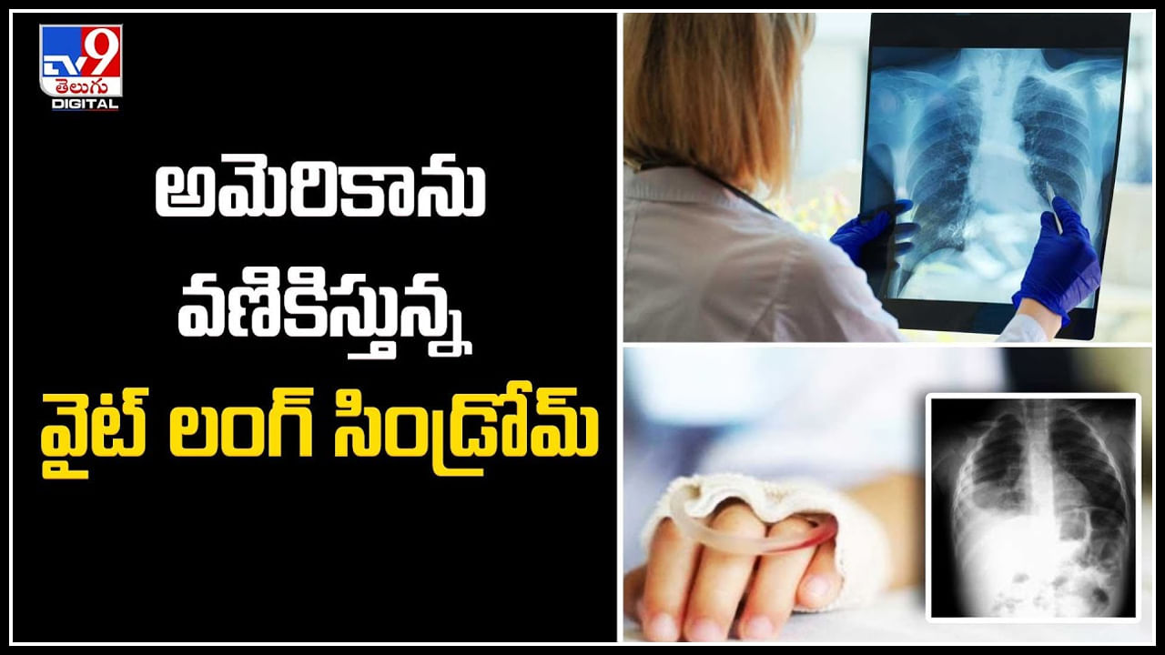 White Lung Syndrome: అమెరికాను వణికిస్తున్న వైట్‌ లంగ్‌ సిండ్రోమ్‌.! యాంటీబయాటిక్స్‌కి లొంగని వ్యాధి !