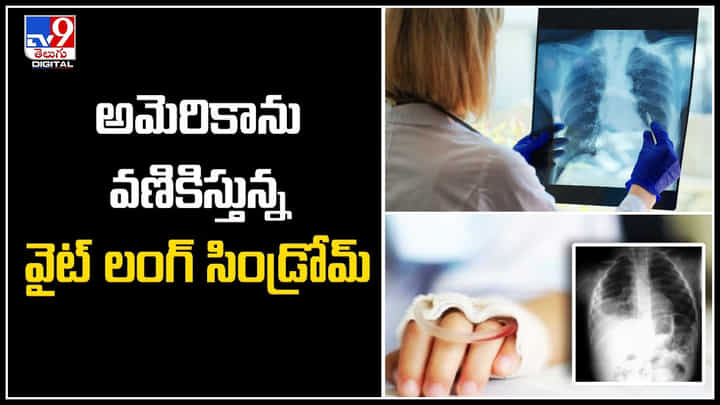 White Lung Syndrome: అమెరికాను వణికిస్తున్న వైట్ లంగ్ సిండ్రోమ్.! యాంటీబయాటిక్స్కి లొంగని వ్యాధి ! White Lung Syndrome: అమెరికాను వణికిస్తున్న వైట్ లంగ్ సిండ్రోమ్.! యాంటీబయాటిక్స్కి లొంగని వ్యాధి !