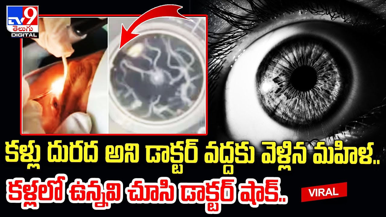 కళ్లు దురద అని డాక్టర్ వద్దకు వెళ్లిన మహిళ.. కళ్లలో ఉన్నవి చూసి డాక్టర్‌ షాక్‌ !!