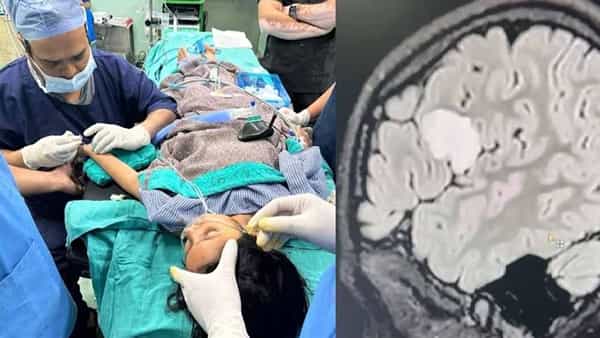 5ఏళ్ల బాలికకు అరుదైన వ్యాధి.. స్పృహలో ఉండగానే బ్రెయిన్ సర్జరీ.. ప్రపంచంలోనే భారత వైద్యుల ఘనత..