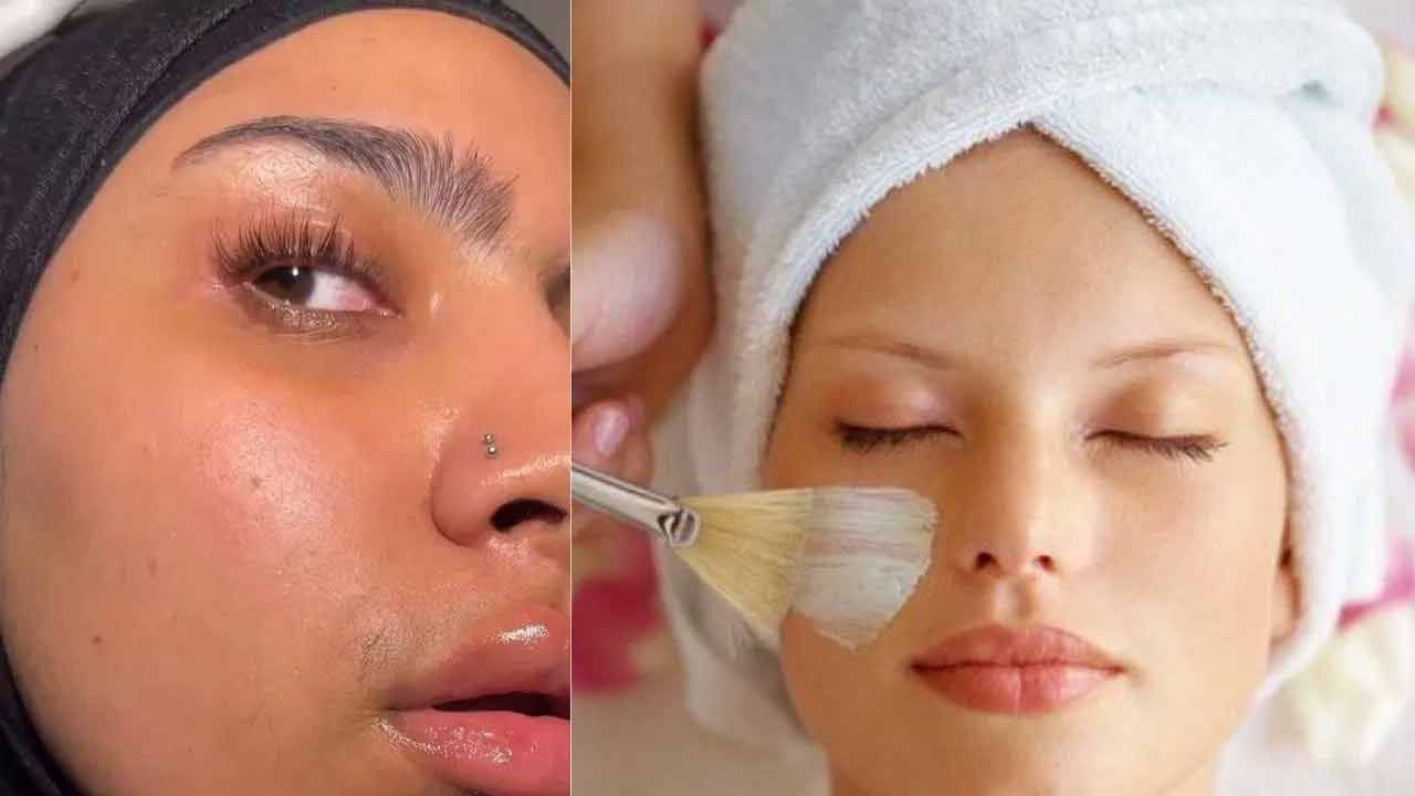 ఈ సమస్య జిడ్డు చర్మానికి మాత్రమే కాదు. పొడి చర్మతత్వం కలిగిన వారికి కూడా ఈ సమస్య ఉంటుంది. ప్రధానంగా చర్మంపై మురికి చేరడం వల్ల ఈ రకమైన సమస్య వస్తుంది. కొన్ని హోమ్‌ రెమెడీస్‌ ద్వారా ఈ సమస్యల నుంచి ఉపశమనం పొందవచ్చు.