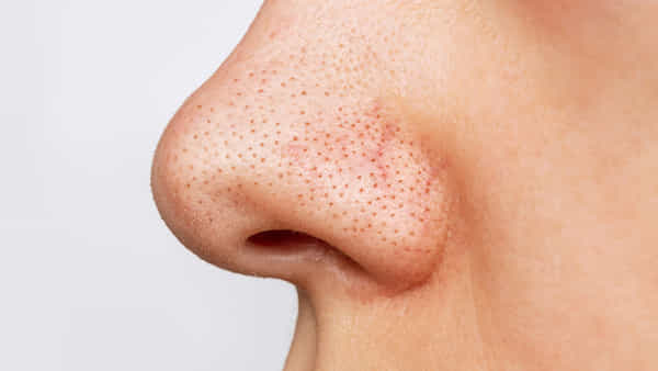 Blackhead: బ్లాక్ హెడ్స్ సమస్య వేధిస్తుందా.? ఇలా సింపుల్గా చెక్ పెట్టండి..