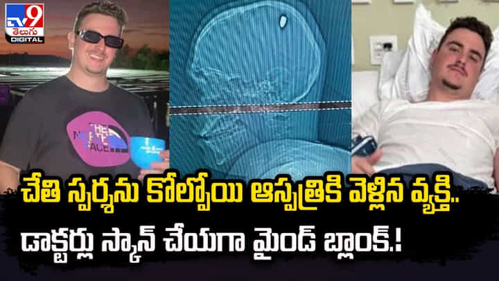 చేతి స్పర్శను కోల్పోయి ఆస్పత్రికి వెళ్లిన వ్యక్తి.. డాక్టర్లు స్కాన్ చేయగా మైండ్ బ్లాంక్ చేతి స్పర్శను కోల్పోయి ఆస్పత్రికి వెళ్లిన వ్యక్తి.. డాక్టర్లు స్కాన్ చేయగా మైండ్ బ్లాంక్