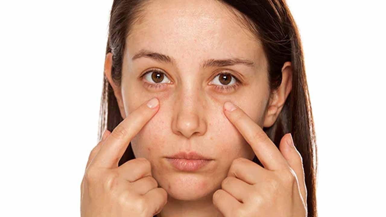 Dark Circles కంటి కింద నల్లటి వలయాలతో ఇబ్బంది పడుతున్నారా.. ఇలా దూరం