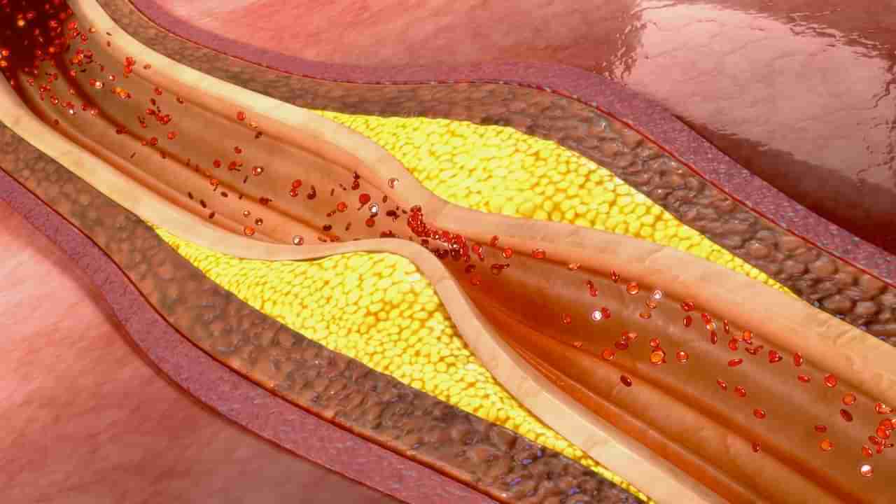 Cholesterol Control Tips: కొలెస్ట్రాల్‌ వెన్నలా కరిగించే దివ్య ఔషధం.. మన వంటింట్లోనే ఉంది!