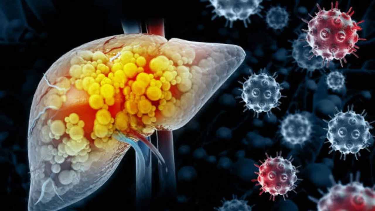 నేటి జీవనశైలి వల్ల యువతలో ఫ్యాటీ లివర్ ముప్పు పెరుగుతుంది. ఫ్యాటీ లివర్‌తో పాటు కాంప్లికేషన్స్ ను పెంచే మరో సమస్య కామెర్లు. కాలేయం సరిగ్గా నిర్విషీకరణ చేయనప్పుడు బిలిరుబిన్ పేరుకుపోతుంది. ఫలితంగా కామెర్లు వ్యాధి ముప్పు సంభవిస్తుంది. ఎర్ర రక్త కణాల విచ్ఛిన్నం ద్వారా బిలిరుబిన్ ఉత్పత్తి అవుతుంది. జీర్ణక్రియ ప్రక్రియ ద్వారా శరీరం నుంచి బిలిరుబిన్ విసర్జించబడుతుంది. కానీ రక్తంలో బిలిరుబిన్ పెరగడం ప్రారంభించిస్తే కామెర్లు సంభవిస్తాయి. అప్పుడు కళ్ళు, చర్మం పసుపు రంగులోకి మారుతాయి. కామెర్లు హెపటైటిస్ వైరస్ వల్ల వస్తుంది. 