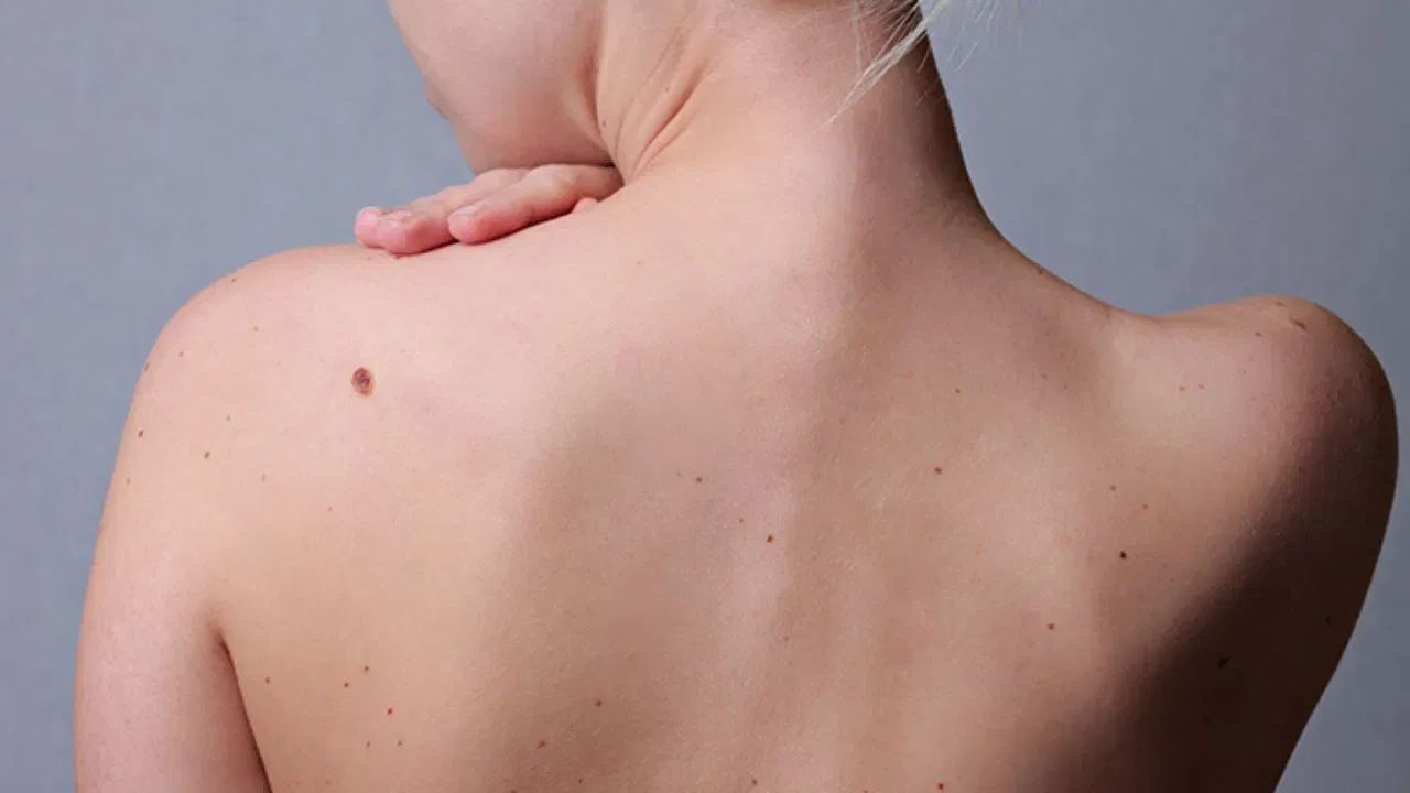 అదే విధంగా కుడి అర చేతిలో పుట్టు మచ్చ ఉండటం కూడా చాలా శుభ ప్రదంగా భావిస్తారు. కుడి చేతిలో పుట్టు మచ్చ ఉంటే సంపన్నమైన, విజయవంతమైన జీవితాన్ని గడుపుతారు. ఇలా వారు డబ్బును ఎక్కువగా సంపాదిస్తారు. విజయం వైపు దూసుకెళ్తారు.