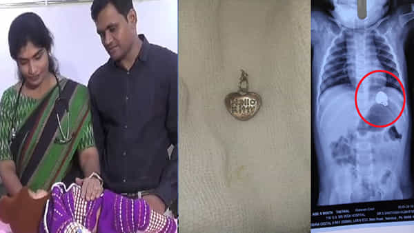 Telangana: చేతికి దొరికిన లాకెట్ను మింగిన ఆరు నెలల చిన్నారి.. ఏమైందంటే..
