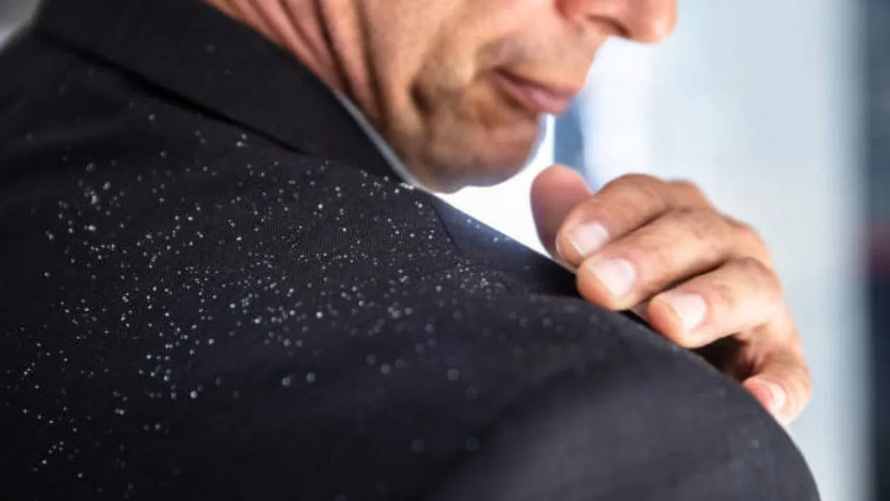 చలికాలంలో చుండ్రు సమస్య మరింత పెరుగుతుంది. ఇక బిజీ లైఫ్‌లో చుండ్రు తొలగింపుకు చాలా మంది ఎలాంటి జాగ్రత్తలు తీసుకోరు. దీంతో తలలో చుండ్రు, దురద మరింత పెరుగుతోంది. యాంటీ-డాండ్రఫ్ చికిత్స కోసం సెలూన్‌కి వెళితే, ఆ ఒక్కసారికి బాగానే ఉంటుంది. ఆ తర్వాత సమస్య యథాతథంగా కొనసాగుతుంది. క్రమం తప్పకుండా సెలూన్‌లో 5-6 ట్రీట్‌మెంట్లు తీసుకుంటే తప్ప చుండ్రు సమస్య తగ్గుముఖం పట్టదు. సహజసిద్ధంగా చుండ్రు సమస్యను తొలగించుకోవాలంటే ఈ కింది టిప్స్‌ ఫాలో అవండి..