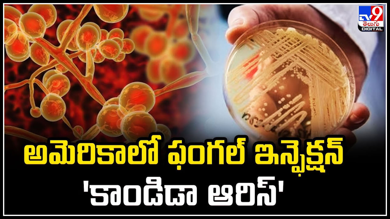 Candida Infection: అమెరికాలో ఫంగల్ ఇన్ఫెక్షన్ 'కాండిడా ఆరిస్'!ఆ రోగులకు ఇన్ఫెక్షన్‌!