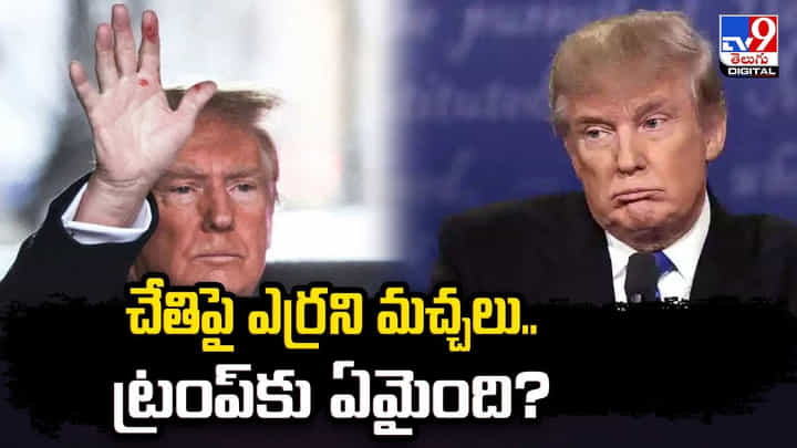 Donald Trump: చేతిపై ఎర్రని మచ్చలు.. ట్రంప్ కు ఏమైంది ?? Donald Trump: చేతిపై ఎర్రని మచ్చలు.. ట్రంప్ కు ఏమైంది ??