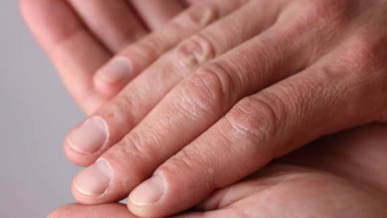 చలికాలంలో చర్మాన్ని ఎలా సంరక్షించుకోవడానికి సాధారణ మాయిశ్చరైజర్ ఉపయోగించాలి. ముఖ్యంగా చమురు ఆధారిత మాయిశ్చరైజర్లు కఠినమైన వాతావరణ పరిస్థితులను ఎదుర్కోవడంలో సహాయపడతాయి. సున్నితమైన చర్మం ఉన్నట్లయితే, ఏదైనా మాయిశ్చరైజర్‌ని ఉపయోగించే ముందు నిపుణుడిని సంప్రదించడం మర్చిపోకూడదు.