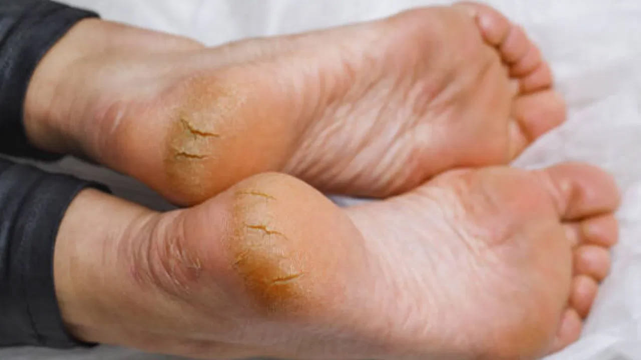 చాలా మంది చలికాలంలో పాదాల పగుళ్లతో బాధపడుతున్నారు. దానిని నిర్లక్ష్యం చేయకూడదు. బయట నుంచి వచ్చిన తర్వాత పాదాలను బాగా శుభ్రం చేసి క్రీమ్ రాసుకోవాలి. పాదాల సమస్యను నివారించడానికి పెట్రోలియం జెల్లీని ఉపయోగించాలి. శరీరంలో విటమిన్ డి లేకపోవడం చర్మ సమస్యలకు దారితీస్తుంది. ఎండలో కూర్చోవడం వల్ల మాత్రమే తగినంత విటమిన్ డి పొందడం సాధ్యం కాదు. చర్మాన్ని ఆరోగ్యంగా ఉంచుకోవడానికి విటమిన్ డి సప్లిమెంట్లను తీసుకోవచ్చు. అలాగే నీళ్లు ఎక్కువగా తాగాలి. తాజా కూరగాయలు, పండ్లు ఎక్కువగా తినాలి.