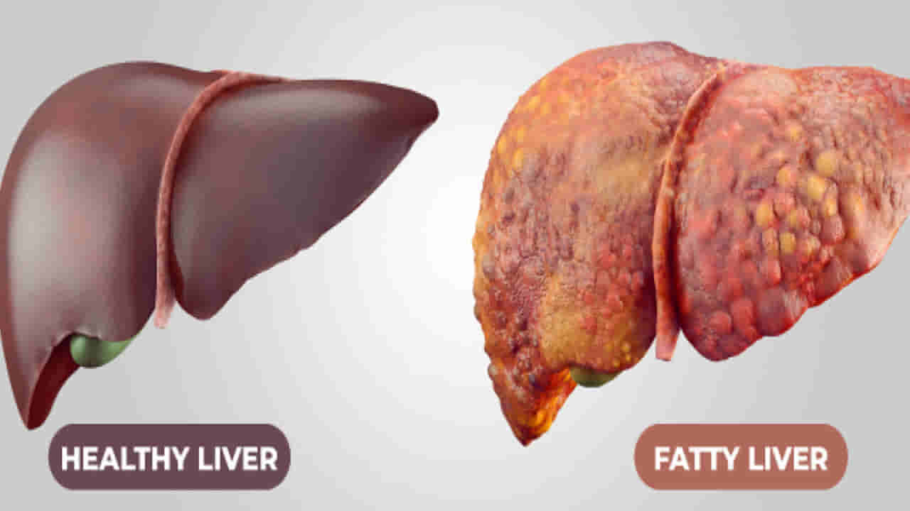 Health: నాన్-ఆల్కహాలిక్ ఫ్యాటీ లివర్కు కారణమేంటి..? దీని నుంచి బయటపడటం ఎలా..?