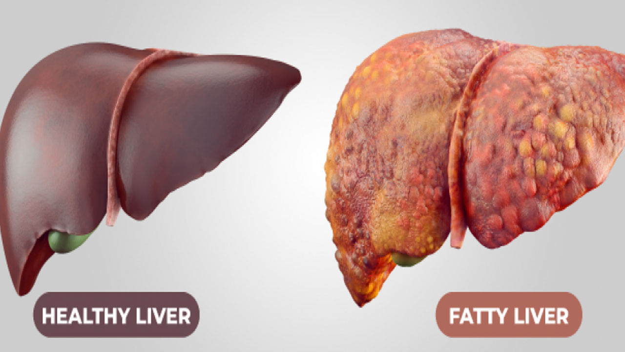 Health: నాన్-ఆల్కహాలిక్ ఫ్యాటీ లివర్కు కారణమేంటి..? దీని నుంచి బయటపడటం ఎలా..?