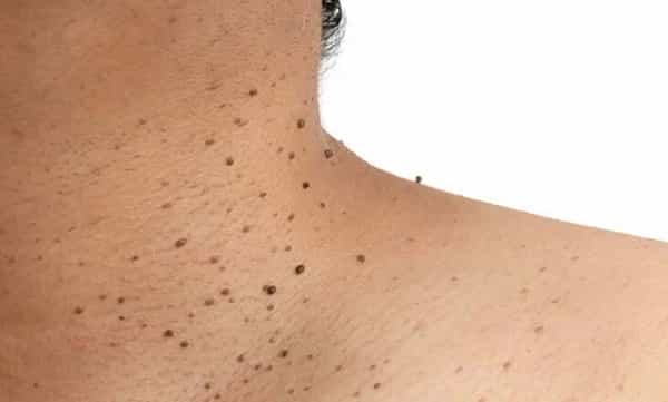 Pulipiri Removal Tips: పులిపిర్లతో చిరాకు వస్తుందా.. వాటికి ఇలా చెక్ పెట్టండి!