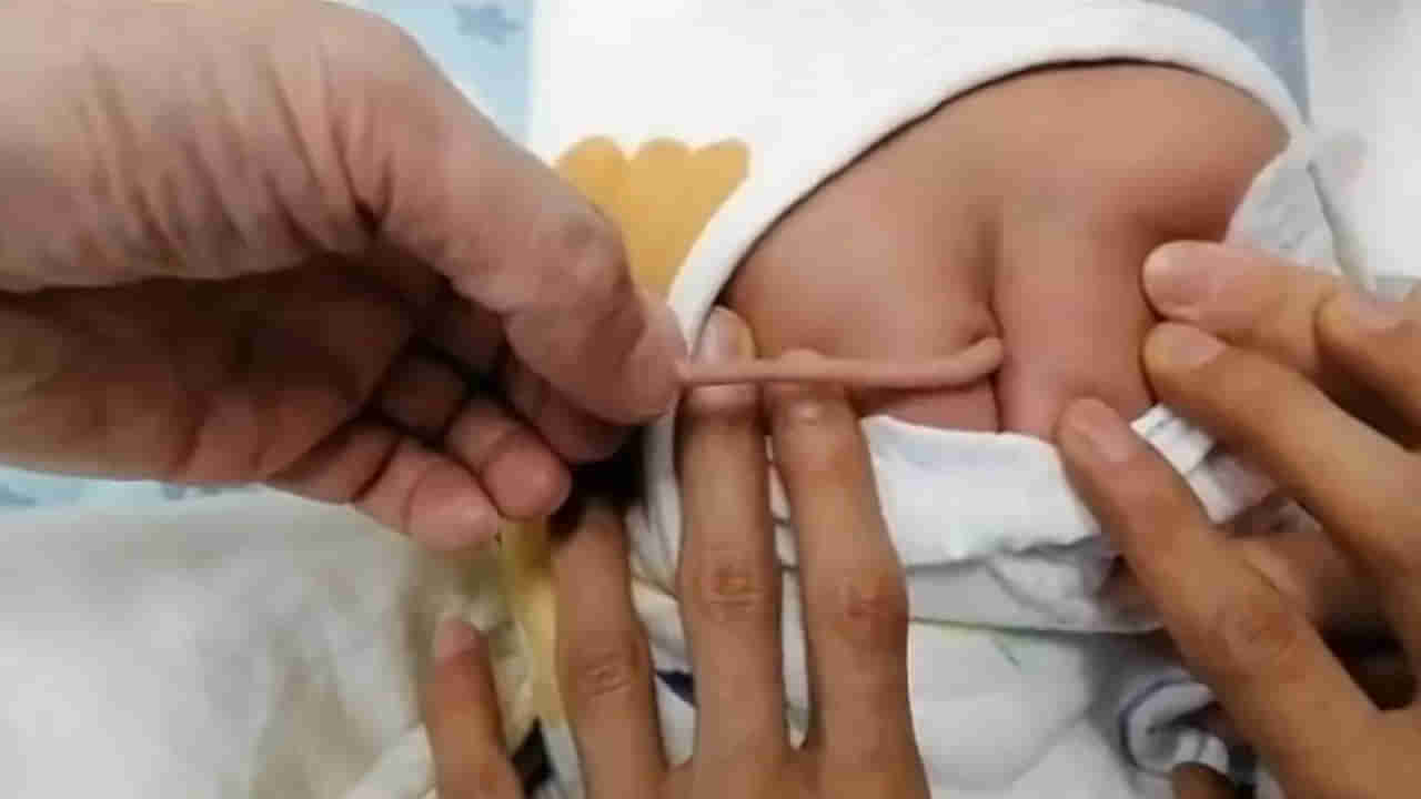 Baby Born with Tail: బ్రహ్మంగారు చెప్పి వింతలు సాక్షాత్కారం.. చైనాలో 4 అంగుళాల తోకతో పుట్టిన శిశువు..