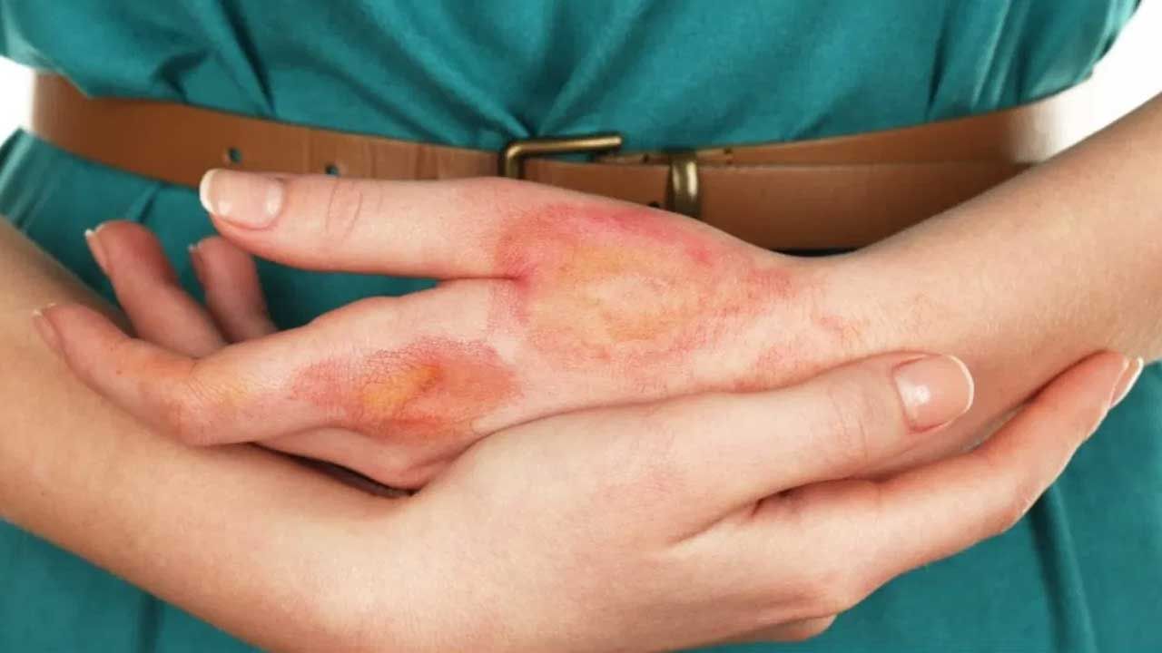 కాలిన గాయాలు ఉంటే అరటి ఆకును అల్లం నూనెలో ముంచి గాయంపై కడితే... త్వరగా మానుతుంది. గర్భిణీ స్త్రీలు అరటి ఆకులను తినడం అలవాటు చేసుకుంటే పుట్టబోయే బిడ్డ ఆరోగ్యం బాగుంటుంది. అరటి ఆకు రసాన్ని ముఖానికి రాసుకుంటే మచ్చలు, దురద వంటి సమస్యలు నయమవుతాయి.