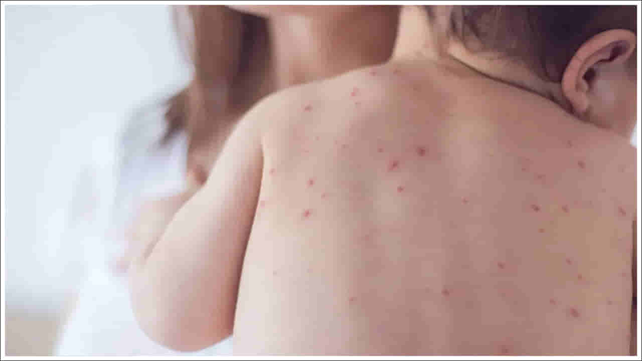 Chicken Pox: పెరుగుతున్న చికెన్ పాక్స్ కేసులు.. దీనిని నివారించడం ఎలా?