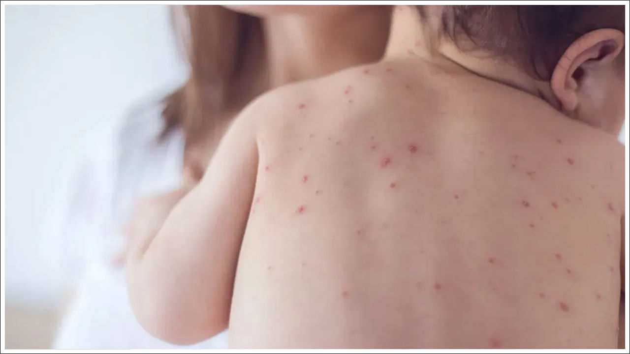 Chicken Pox: పెరుగుతున్న చికెన్ పాక్స్ కేసులు.. దీనిని నివారించడం ఎలా?