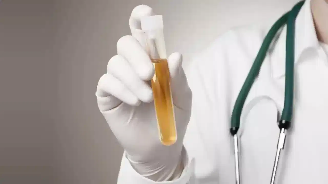 ఈ రంగు డీహైడ్రేషన్ను సూచిస్తుంది. అంటే మీరు సరిగ్గా నీళ్లు తాగడం లేదని అర్థం. మరింతగా నీళ్లు, ఫ్లూయిడ్స్ అనేవి తాగుతూ ఉండాలి. అలాగే మూత్రం నారింజ రంగులో వస్తుంటే మాత్రం.. ట్యాబ్లెట్లను వాడుతున్నారని అర్థం చేసుకోవచ్చు.