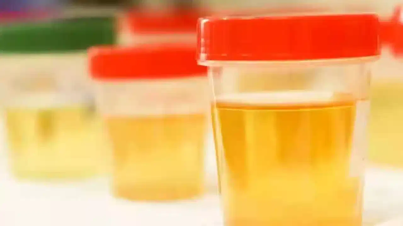 లివర్ లేదా పిత్తాశయ సమస్యలు ఉన్నా కూడా నారింజ రంగులో మూత్రం వస్తుంది. ఇంకొందరికి ఎరుపు లేదా పింక్ రంగులో వస్తుంది. ఇలా వస్తే.. కిడ్నీలో స్టోన్లు, యూరినరీ ట్రాక్ట్ ఇన్ ఫెక్షన్, మూత్రాశయ ఇన్ ఫెక్షన్ల బారిన పడ్డారని అర్థం. కాబట్టి వెంటనే వైద్యుల్ని సంప్రదించడం మేలు.