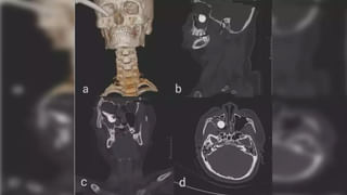 వింత వ్యాధి బారినపడిన యువతి.. 4 వస్తువులు మినహా వేడి, చలి, అన్నీ అలెర్జీనే..