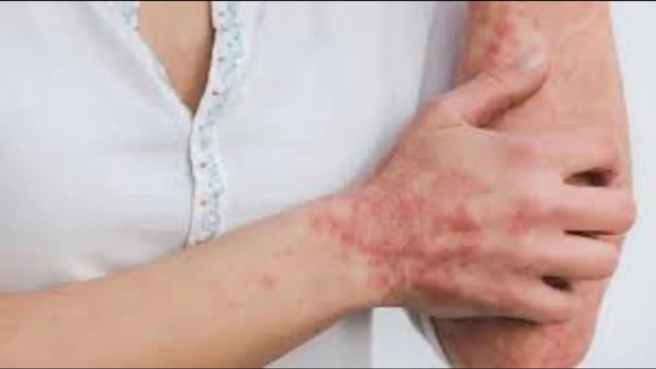 Eczema Reduce Tips 1