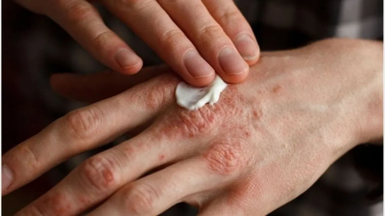 Eczema Reduce Tips 2