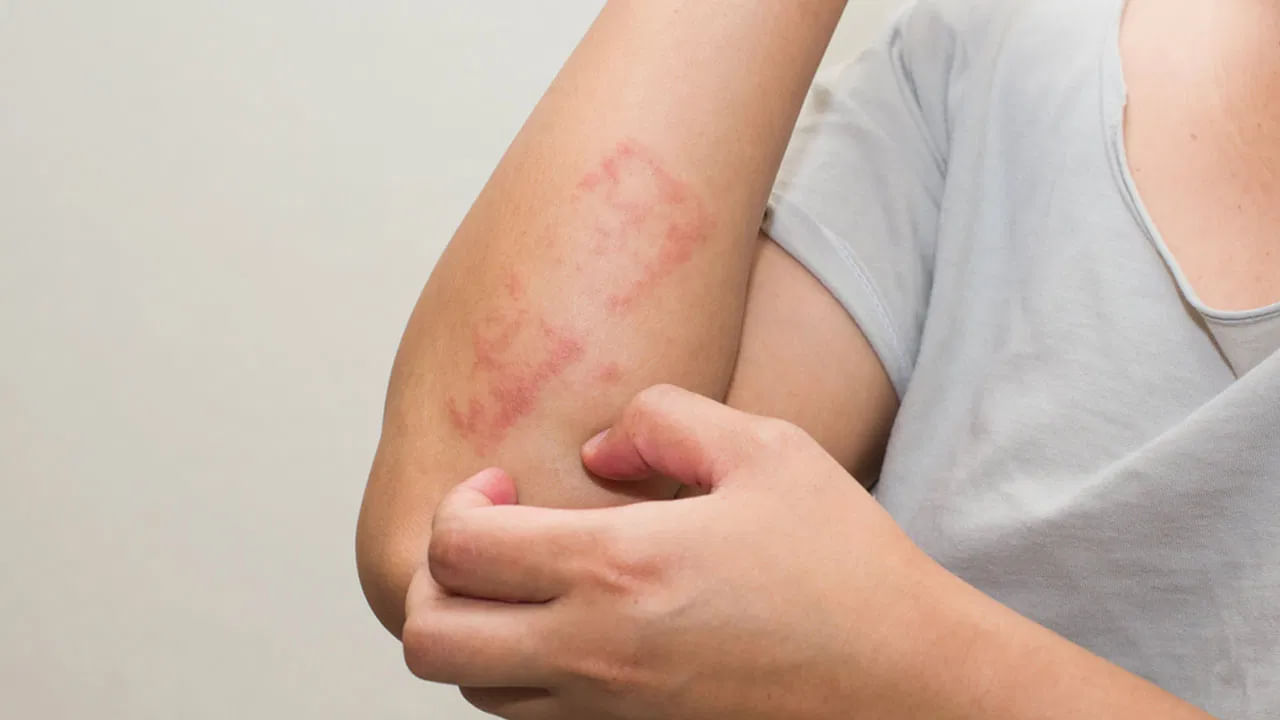 Eczema Reduce Tips 3