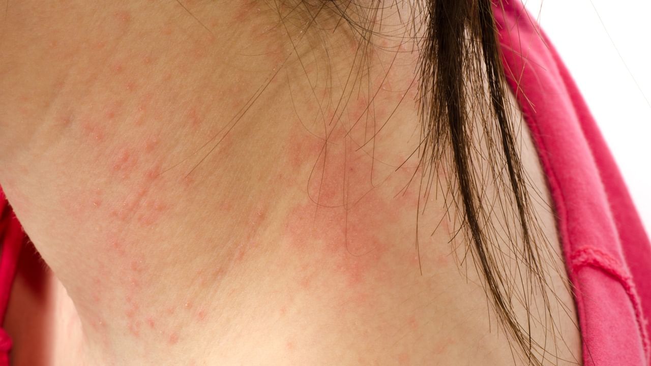 Eczema Reduce Tips 4