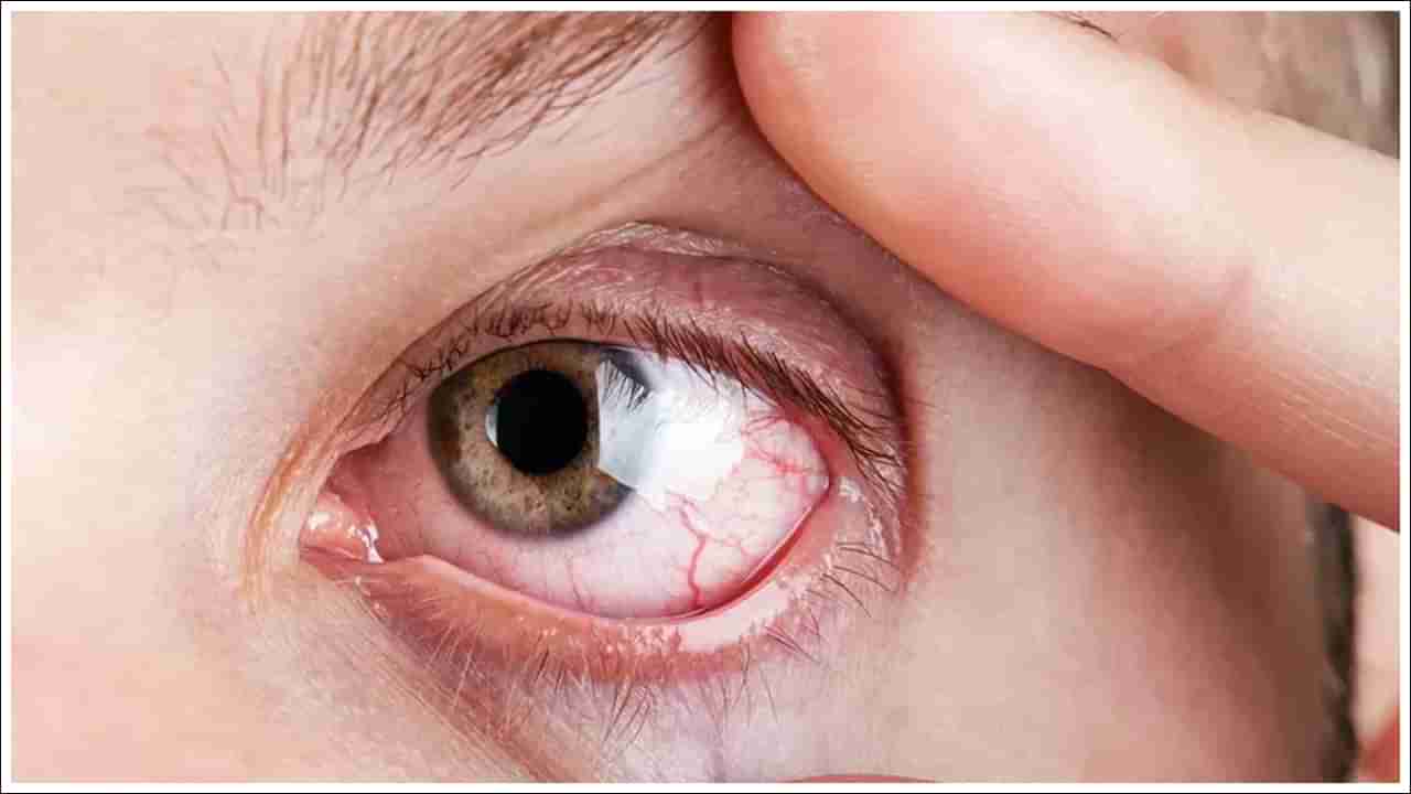 Eye Irritation: వేసవిలో కళ్లు తరచుగా చికాకు కలిగిస్తున్నాయా? సింపుల్‌ చిట్కాలతో మీ కళ్లకు విశ్రాంతి