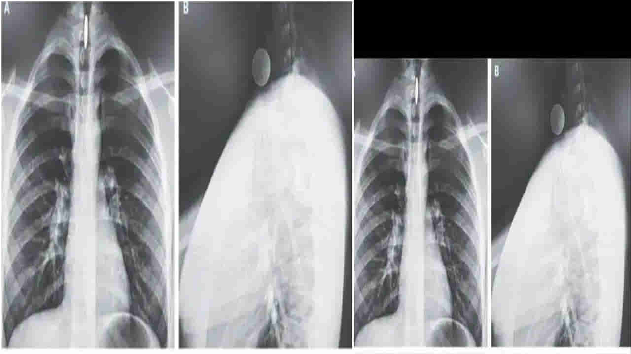 Viral: సరదా.. సరదాగా నాణేన్ని మింగేశాడు.. కట్ చేస్తే.. ఎక్స్‌రే చూడగా డాక్టర్లు పరేషాన్.!