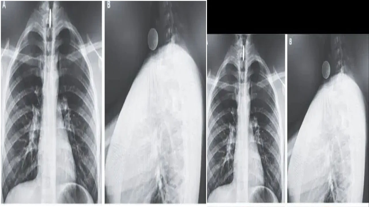 Viral: సరదా.. సరదాగా నాణేన్ని మింగేశాడు.. కట్ చేస్తే.. ఎక్స్‌రే చూడగా డాక్టర్లు పరేషాన్.!