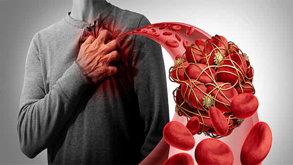 Blood Clots: శరీరంలో రక్తం గడ్డకట్టడానికి కారణాలు ఇవే.. జాగ్రత్త! ప్రాణాలకు ప్రమాదం..