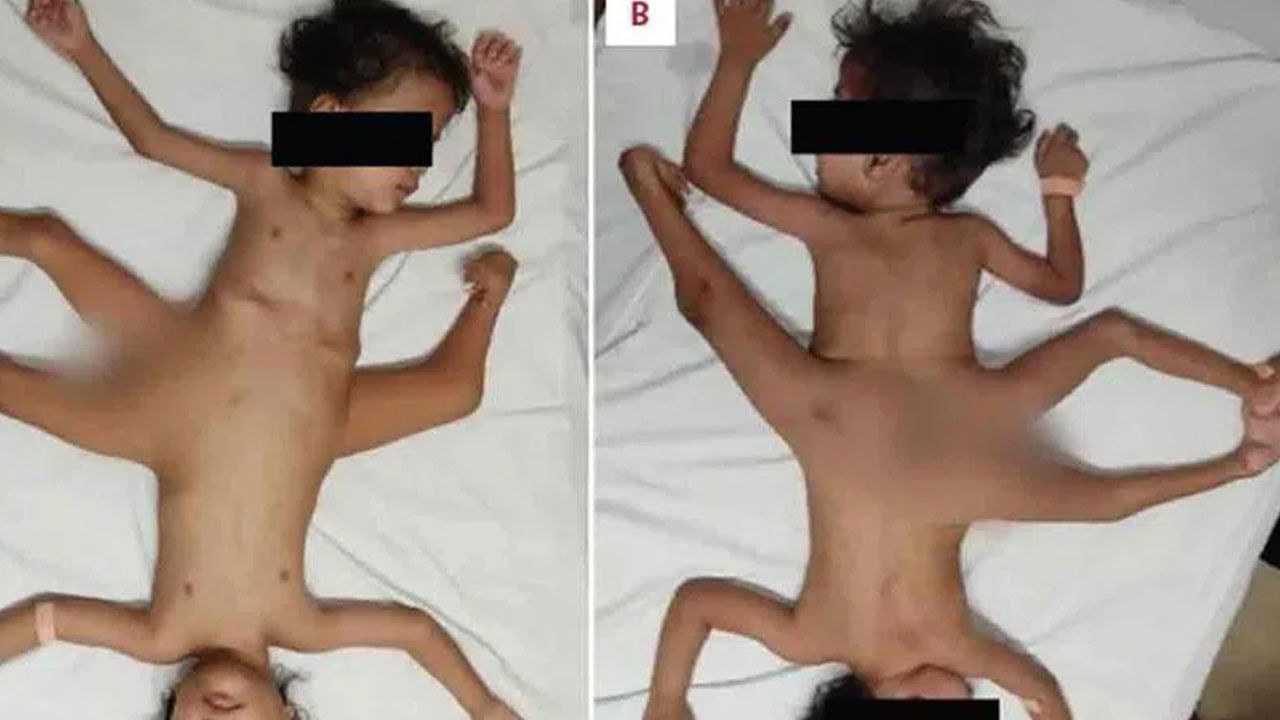 Conjoined Twins: అరుదైన అవిభక్త కవలల జననం.. 20లక్షల మందిలో ఒకరు ఇలా..