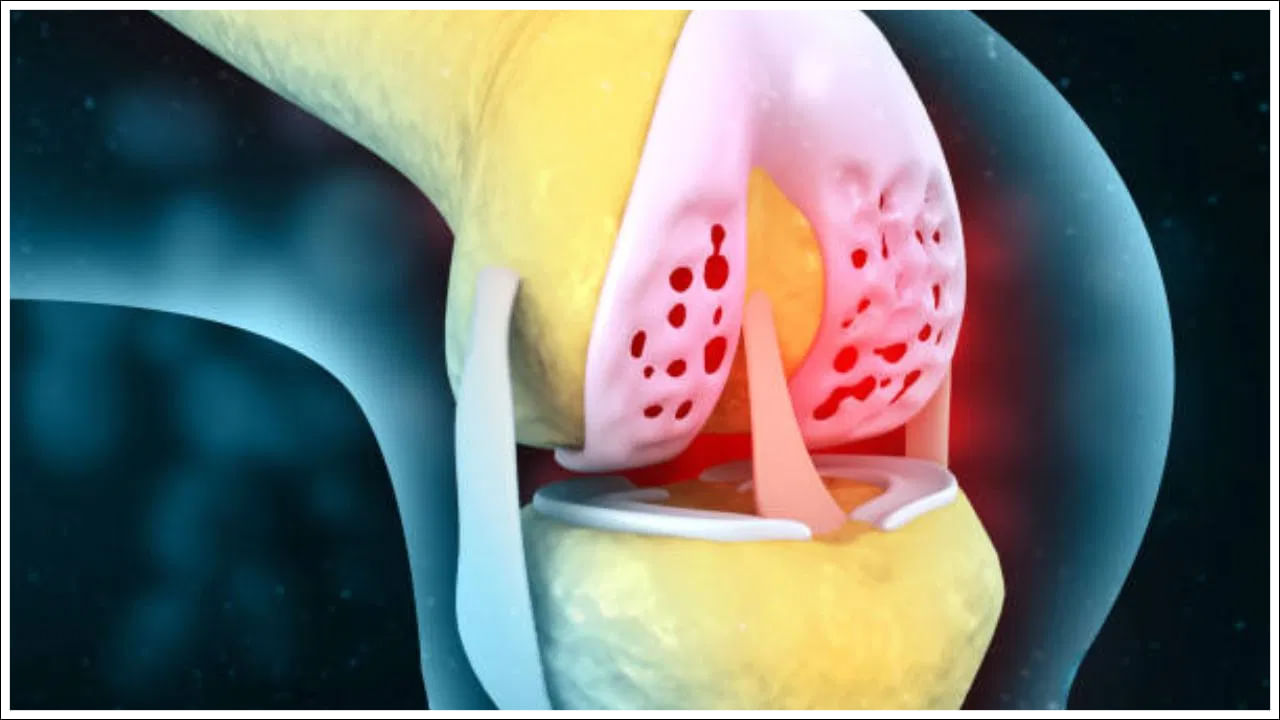 కీళ్లలోని కుషన్ కోతకు గురికావడం వల్ల నొప్పి తీవ్రమవుతుంది. ప్రాథమికంగా, కుషన్ కోత ఉమ్మడిలోని రెండు ఎముకల మధ్య ఘర్షణకు దారితీస్తుంది. దీనివల్ల నొప్పి తీవ్రమవుతుంది.