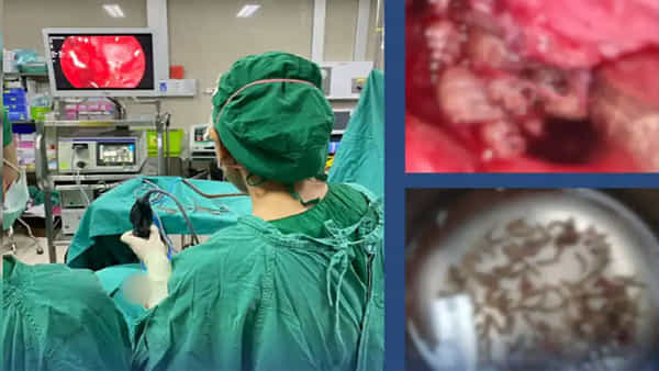 Insects inside Nose: బాబోయ్.. మహిళ ముక్కులో వందల పురుగులు! ఖంగు తిన్న వైద్యులు