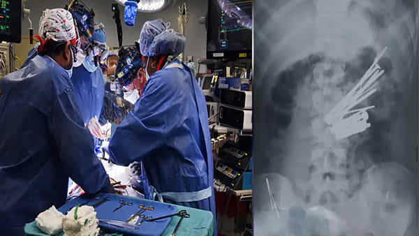 Surgery: కడుపు నొప్పితో ఆస్పత్రికి వచ్చిన యువకుడు.. ఎక్స్రే తీసి చూడగా అవాక్కైన వైద్యులు!