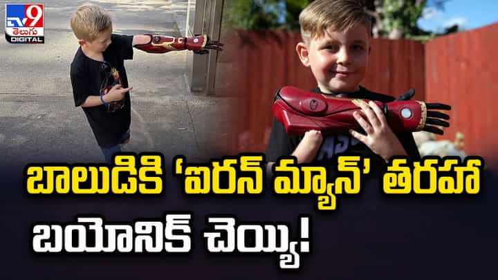 బాలుడికి ‘ఐరన్ మ్యాన్’ తరహా బయోనిక్ చెయ్యి బాలుడికి ‘ఐరన్ మ్యాన్’ తరహా బయోనిక్ చెయ్యి