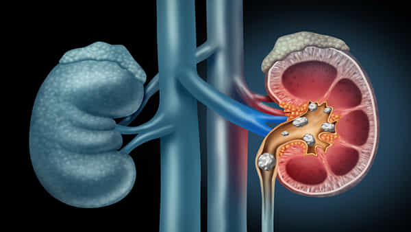 Health Benefits: ఖాళీ కడుపుతో ఈ పండును తినండి.. కిడ్నీలో రాళ్లు తేలికగా కరిగిపోతాయి..!