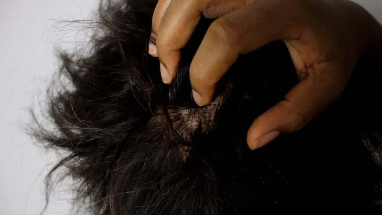 Get Rid of Lice: తలంతా పేలు పుచ్చిపోయాయా.. ఈ చిట్కా ట్రై చేశారంటే ఒక్కదెబ్బకే రాలతాయ్!