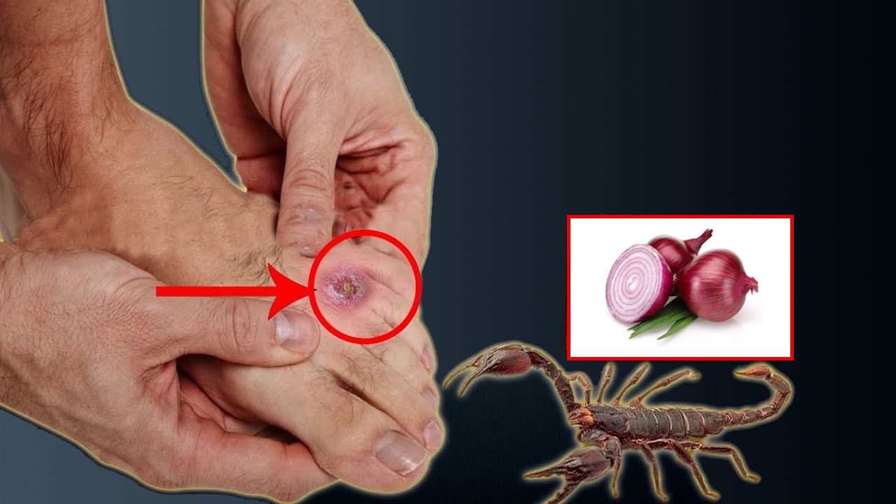 Scorpion sting: తేలు కుట్టిన చోట ఉల్లిపాయ రుద్దితే విషం విరిగిపోతుందా..?
