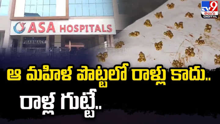 ఆ మహిళ పొట్టలో రాళ్లు కాదు.. రాళ్ల గుట్టే ఉంది ఆ మహిళ పొట్టలో రాళ్లు కాదు.. రాళ్ల గుట్టే ఉంది