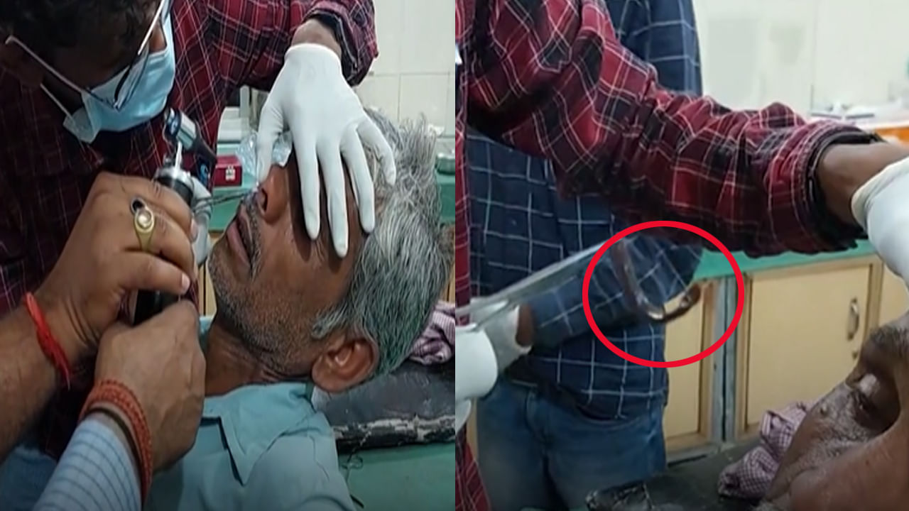 వృద్ధ రైతుకు తీవ్రమైన తలనొప్పి.. ఆస్పత్రి వెళ్లగా.. ముక్కులో ఏముందో చూసి డాక్టర్లు షాక్